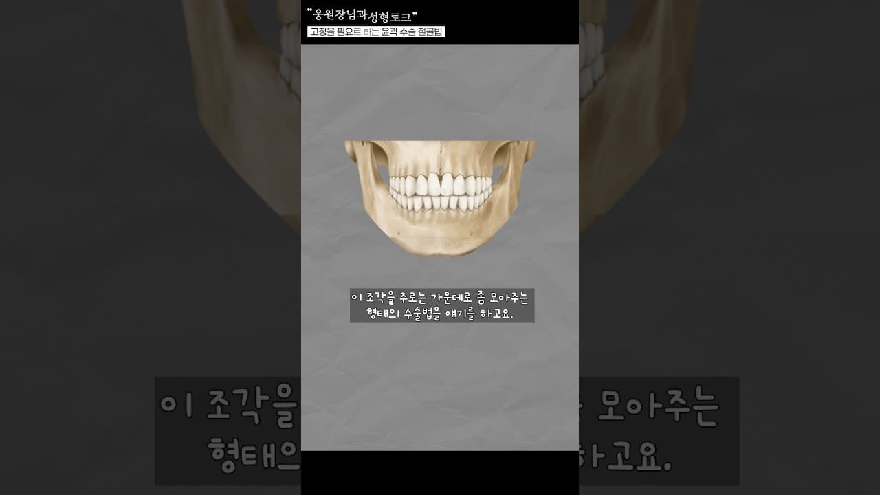 앞턱수술, T절골과 ㅅ절골의 차이!