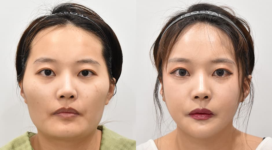 前下顎截骨 顴骨 方形下顎