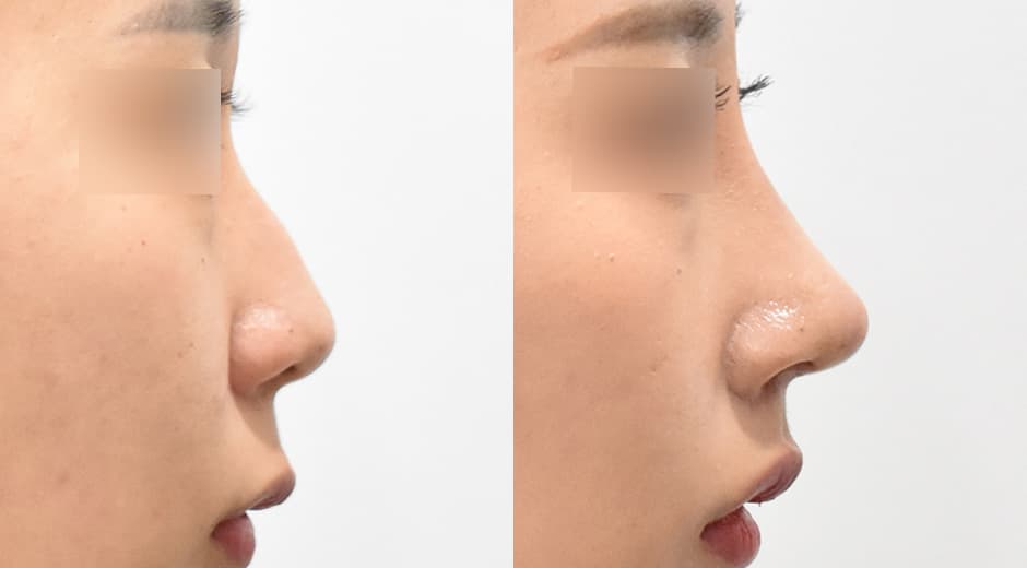 人中鼻(第一次手術) 縮短人中
