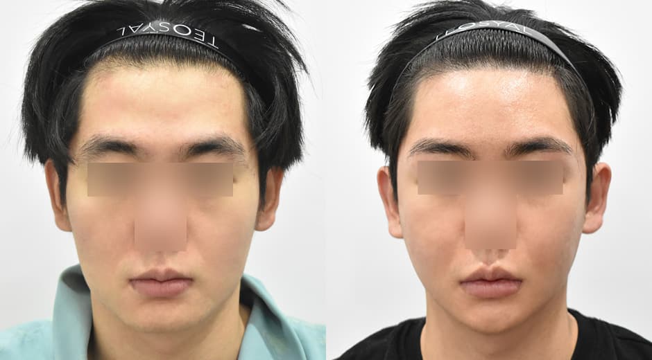 縮小方形下顎 前下顎截骨