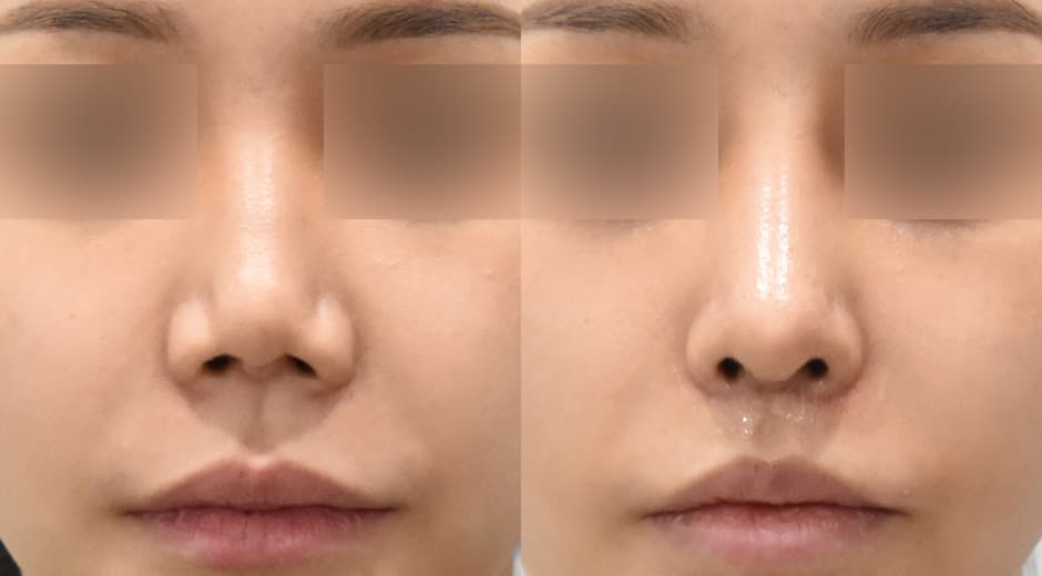 人中鼻(二次修復手術) 縮短人中