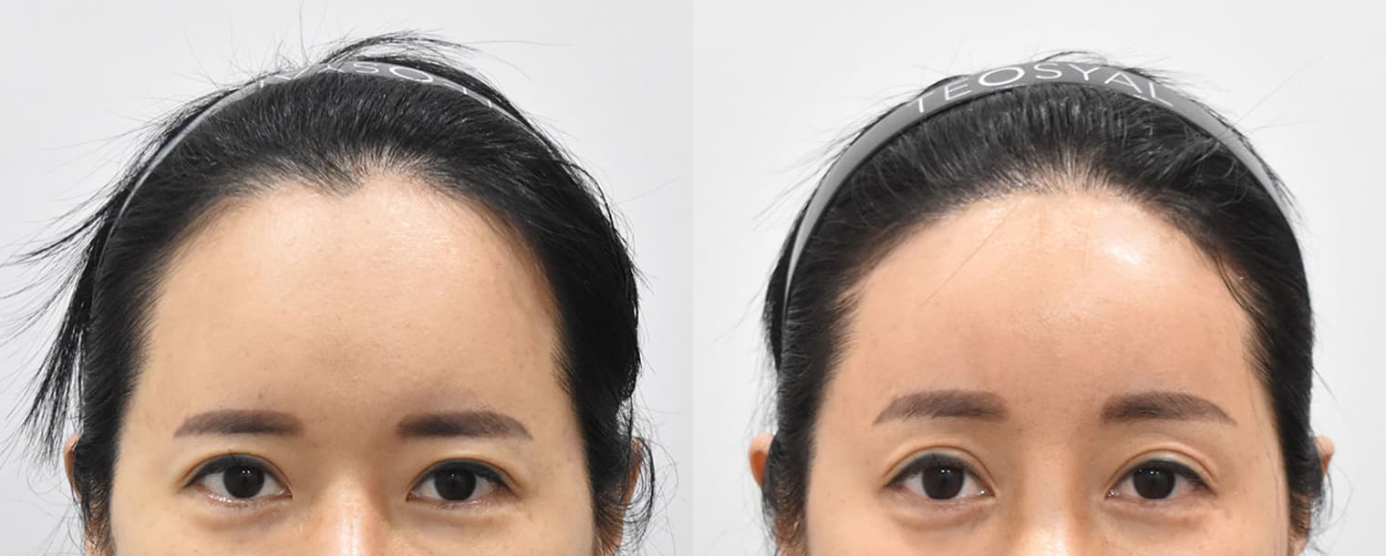 縮小額頭 額頭提升