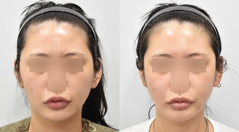 縮小顴骨 縮小方形下顎 前下顎截骨