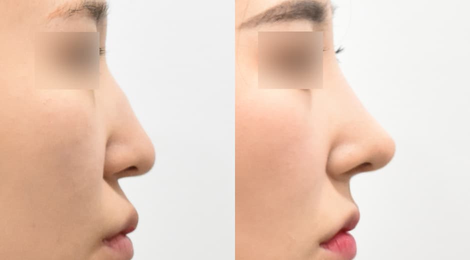 人中鼻(第一次手術)