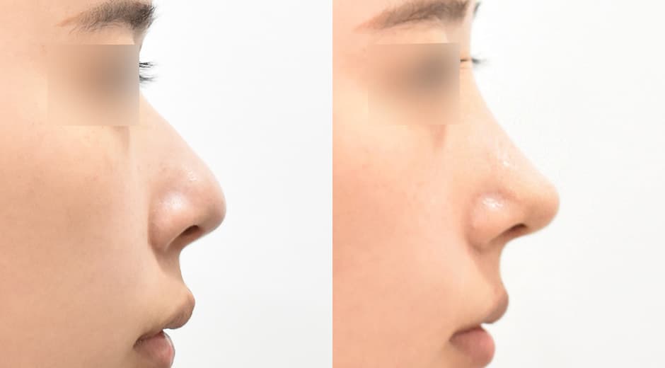 人中鼻(第一次手術)