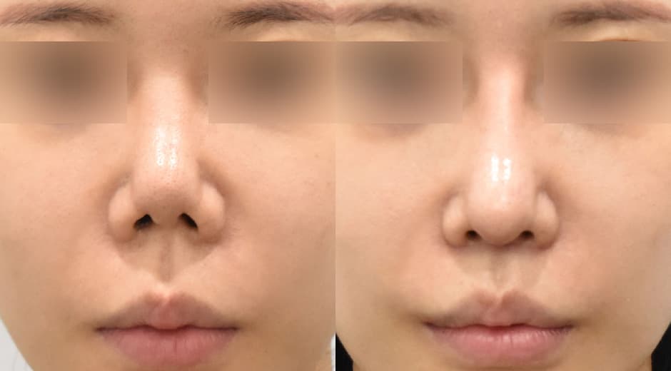 人中鼻(二次修復手術) 縮短人中