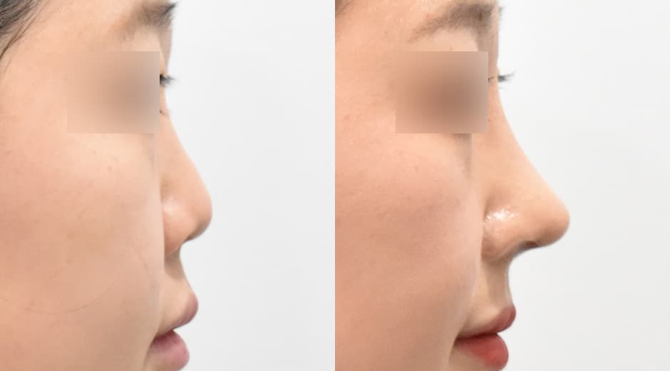 人中鼻(第一次手術)