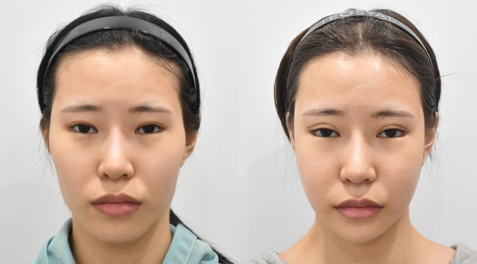 前下顎截骨 顴骨 方形下顎