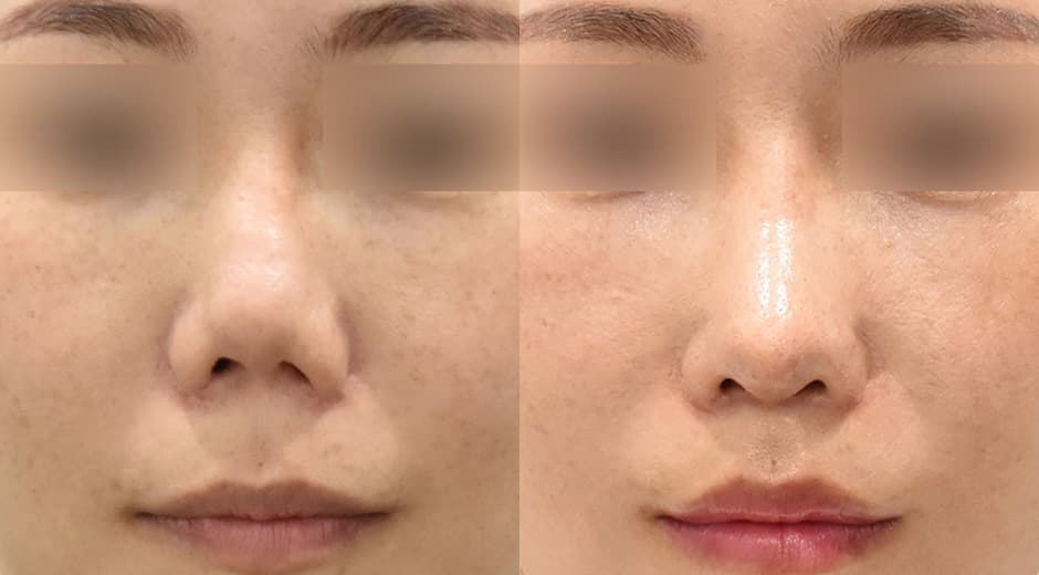 人中鼻(二次修復手術) 縮短人中