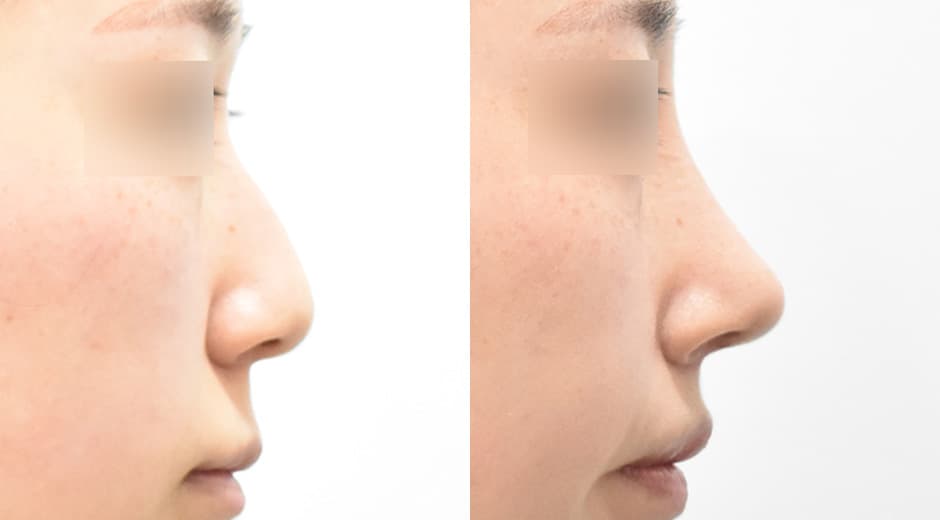 人中鼻(第一次手術) 縮短人中