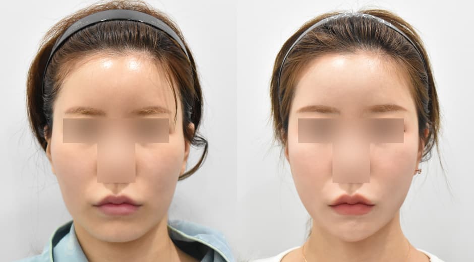 縮小顴骨 縮小方形下顎 前下顎截骨
