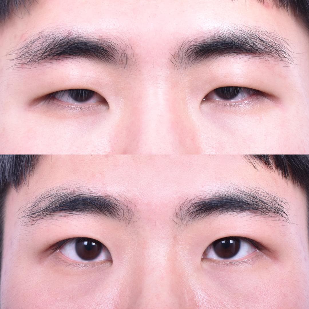 非切開眼型矯正(1個月後)