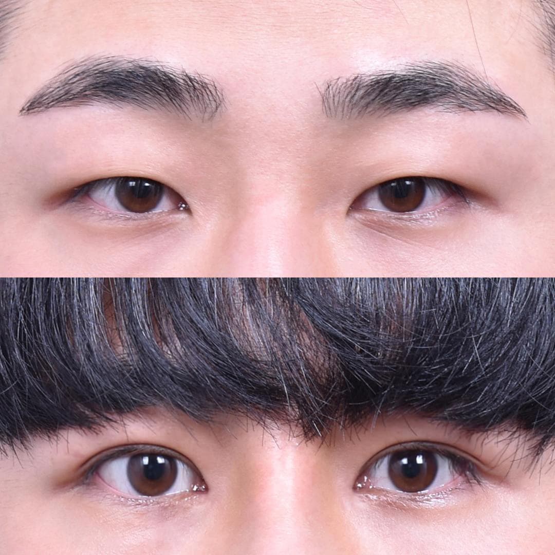 非切開眼型矯正 + 前眼角開大(2週後)